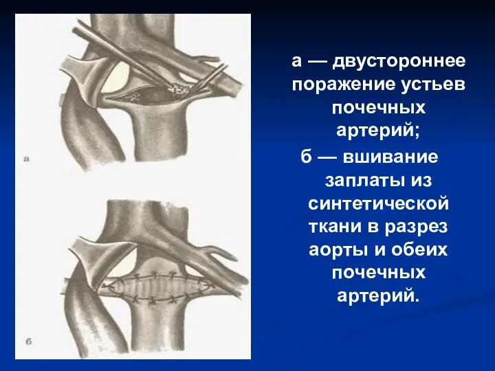 а — двустороннее поражение устьев почечных артерий; б — вшивание