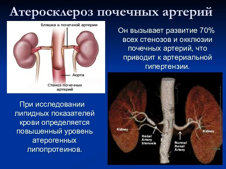 Атеросклероз почечных артерий Он вызывает развитие 70% всех стенозов и