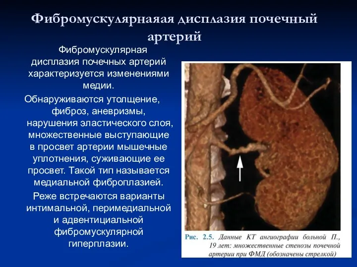 Фибромускулярнаяая дисплазия почечный артерий Фибромускулярная дисплазия почечных артерий характеризуется изменениями