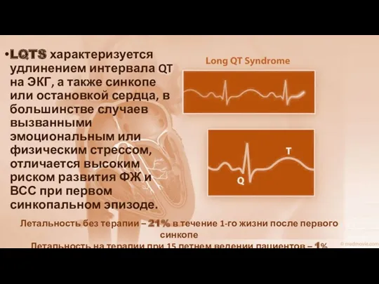 LQTS характеризуется удлинением интервала QT на ЭКГ, а также синкопе