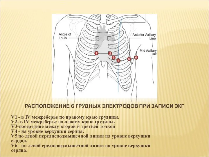 РАСПОЛОЖЕНИЕ 6 ГРУДНЫХ ЭЛЕКТРОДОВ ПРИ ЗАПИСИ ЭКГ V1 - в