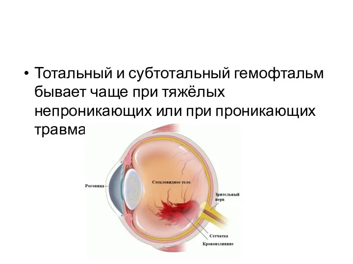 Тотальный и субтотальный гемофтальм бывает чаще при тяжёлых непроникающих или при проникающих травмах глаза.