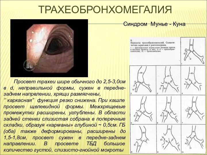 ТРАХЕОБРОНХОМЕГАЛИЯ Просвет трахеи шире обычного до 2,5-3,0см в d, неправильной