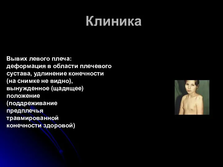 Клиника Вывих левого плеча: деформация в области плечевого сустава, удлинение конечности (на снимке