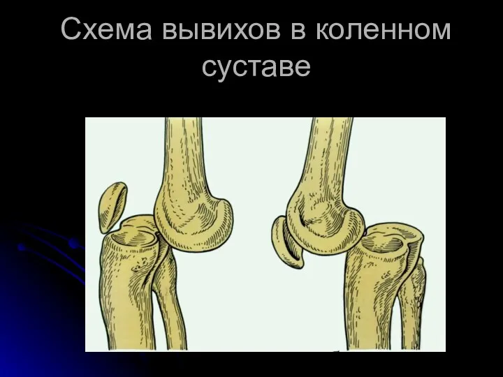 Схема вывихов в коленном суставе