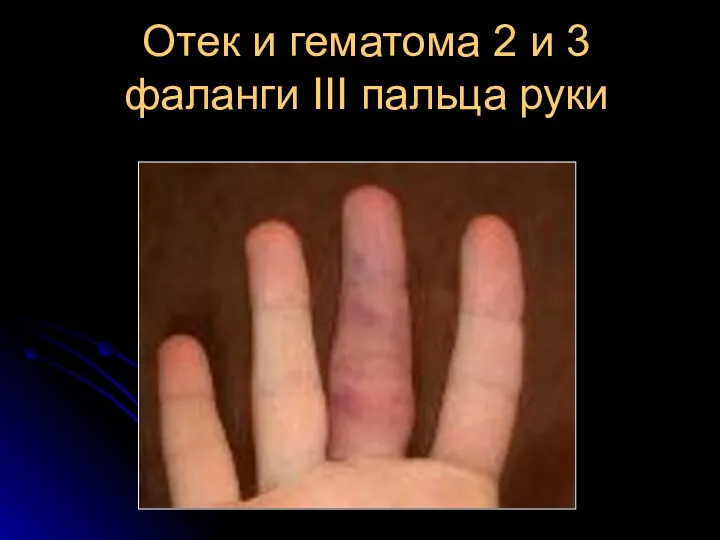 Отек и гематома 2 и 3 фаланги III пальца руки