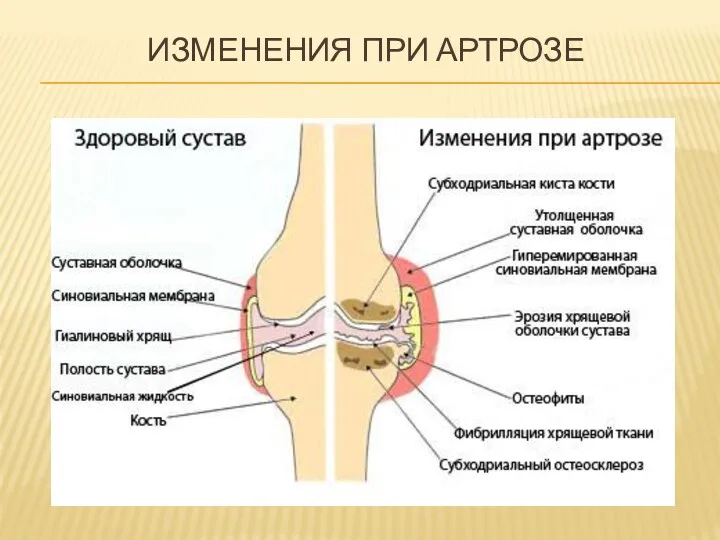 ИЗМЕНЕНИЯ ПРИ АРТРОЗЕ