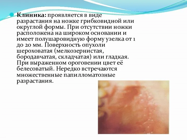 Клиника: проявляется в виде разрастания на ножке грибковидной или округлой