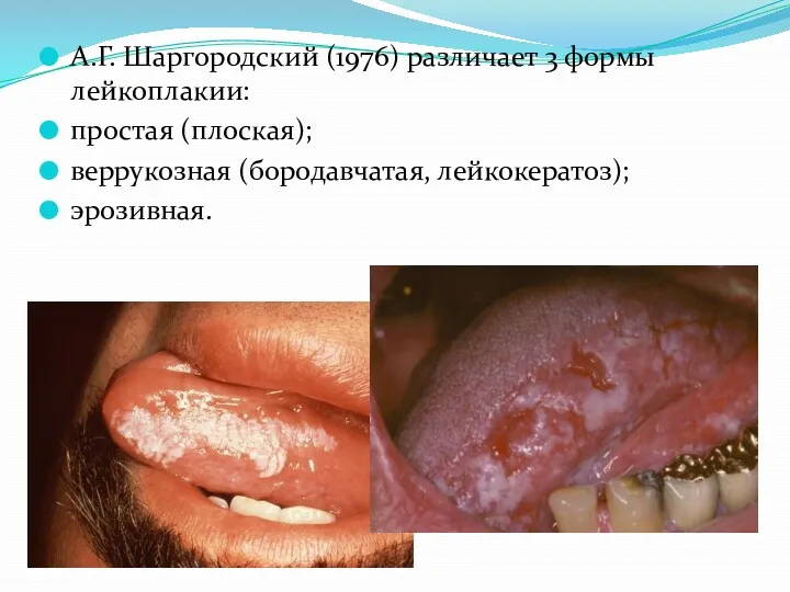 А.Г. Шаргородский (1976) различает 3 формы лейкоплакии: простая (плоская); веррукозная (бородавчатая, лейкокератоз); эрозивная.