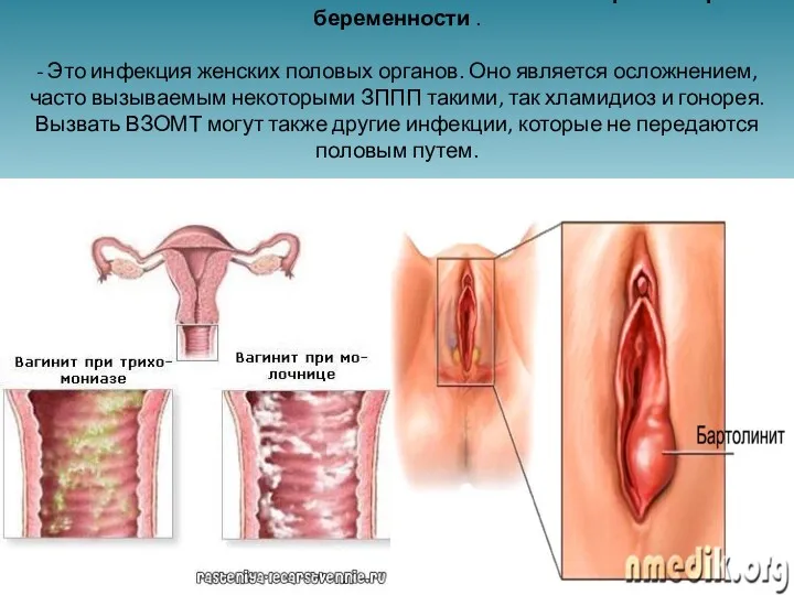 Воспалительные заболевания женских половых органов при беременности . - Это инфекция женских половых