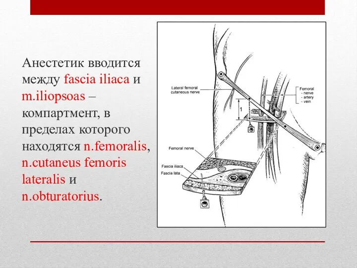 Анестетик вводится между fascia iliaca и m.iliopsoas – компартмент, в