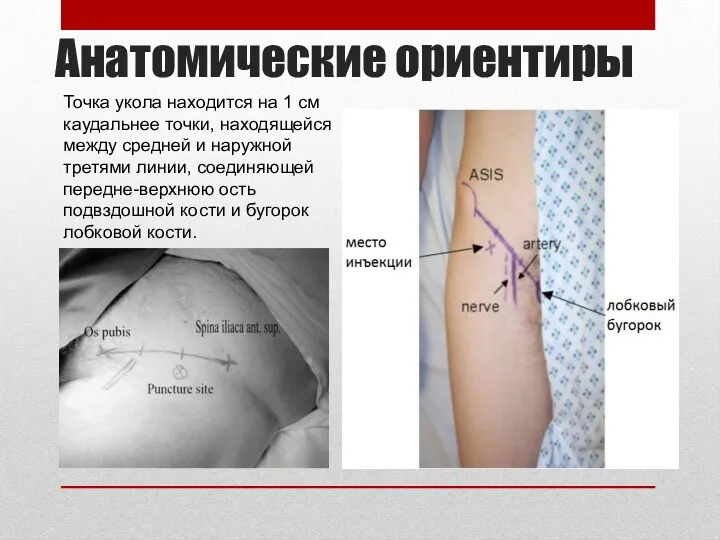 Анатомические ориентиры Точка укола находится на 1 см каудальнее точки,