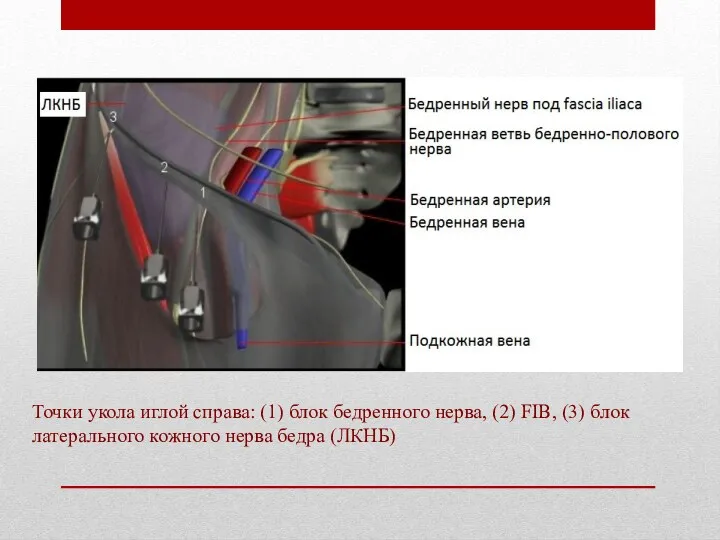 Точки укола иглой справа: (1) блок бедренного нерва, (2) FIB,