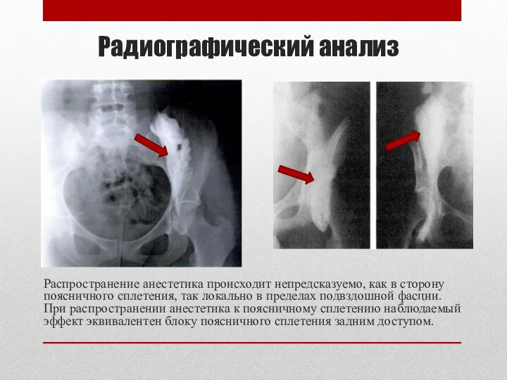 Распространение анестетика происходит непредсказуемо, как в сторону поясничного сплетения, так