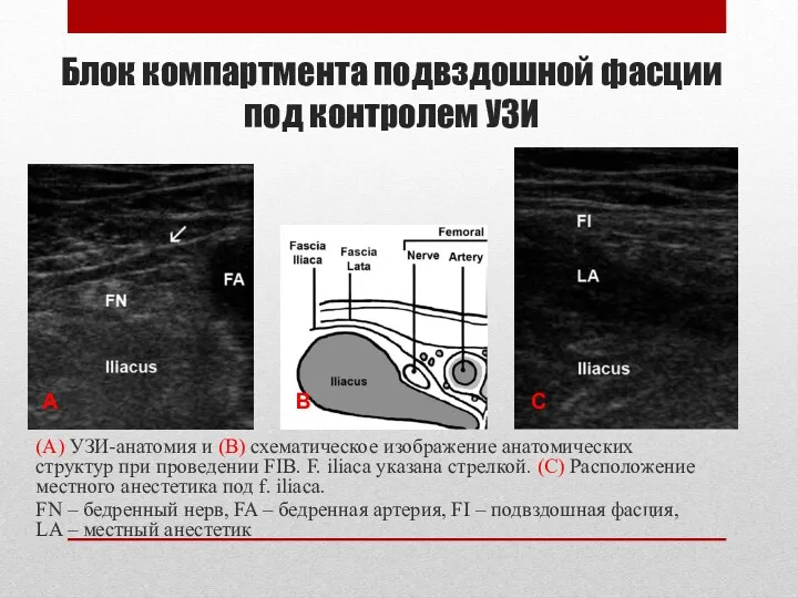 Блок компартмента подвздошной фасции под контролем УЗИ А В С