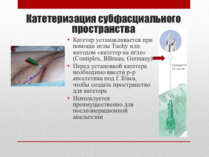 Катетеризация субфасциального пространства Катетер устанавливается при помощи иглы Tuohy или