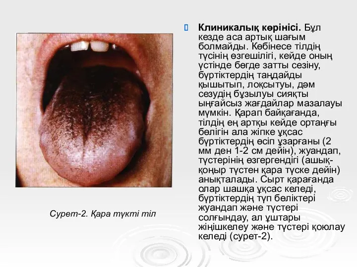 Клиникалық көрінісі. Бұл кезде аса артық шағым болмайды. Көбінесе тілдің