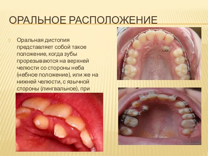 ОРАЛЬНОЕ РАСПОЛОЖЕНИЕ Оральная дистопия представляет собой такое положение, когда зубы