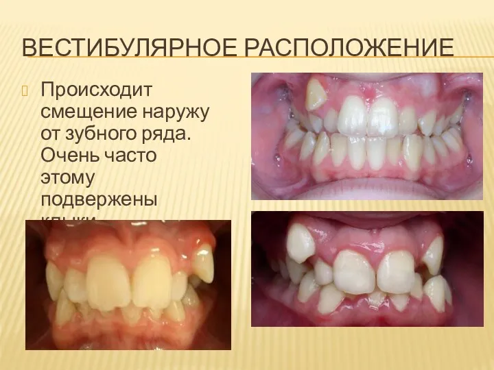 ВЕСТИБУЛЯРНОЕ РАСПОЛОЖЕНИЕ Происходит смещение наружу от зубного ряда. Очень часто этому подвержены клыки.