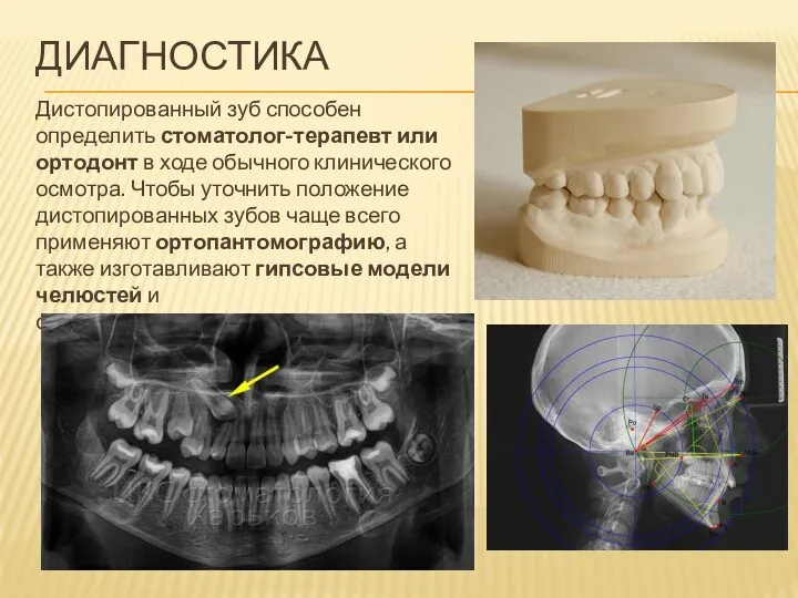 ДИАГНОСТИКА Дистопированный зуб способен определить стоматолог-терапевт или ортодонт в ходе