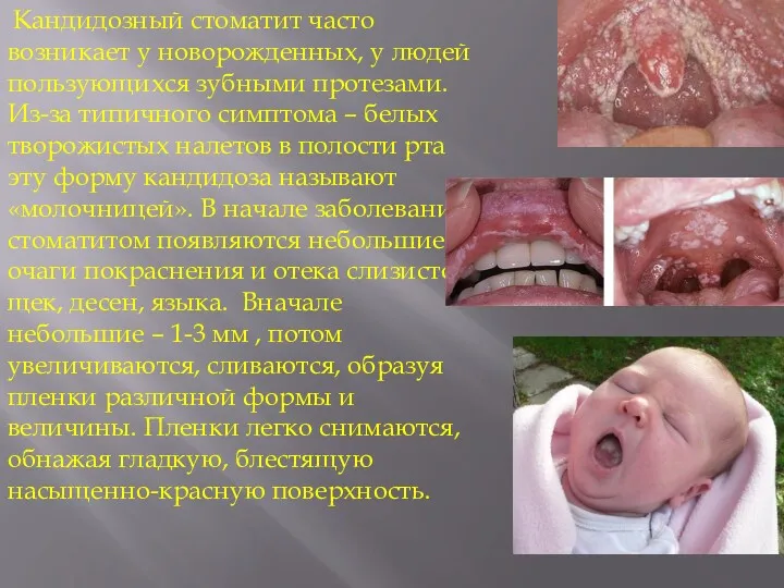 Кандидозный стоматит часто возникает у новорожденных, у людей пользующихся зубными