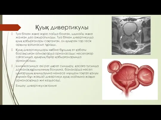 Қуық дивертикулы Туа біткен және жүре пайда болған, шынайы және