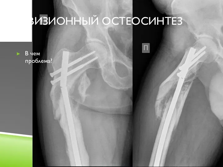 РЕВИЗИОННЫЙ ОСТЕОСИНТЕЗ В чем проблема?