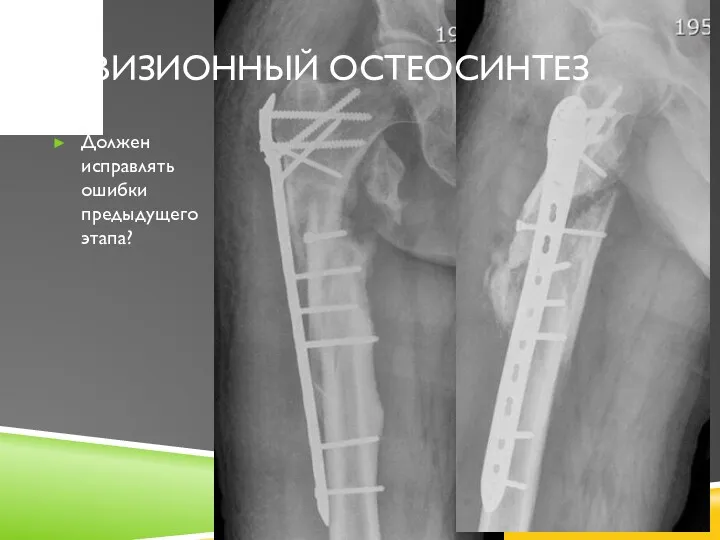 Должен исправлять ошибки предыдущего этапа? РЕВИЗИОННЫЙ ОСТЕОСИНТЕЗ