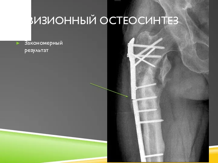 Закономерный результат РЕВИЗИОННЫЙ ОСТЕОСИНТЕЗ