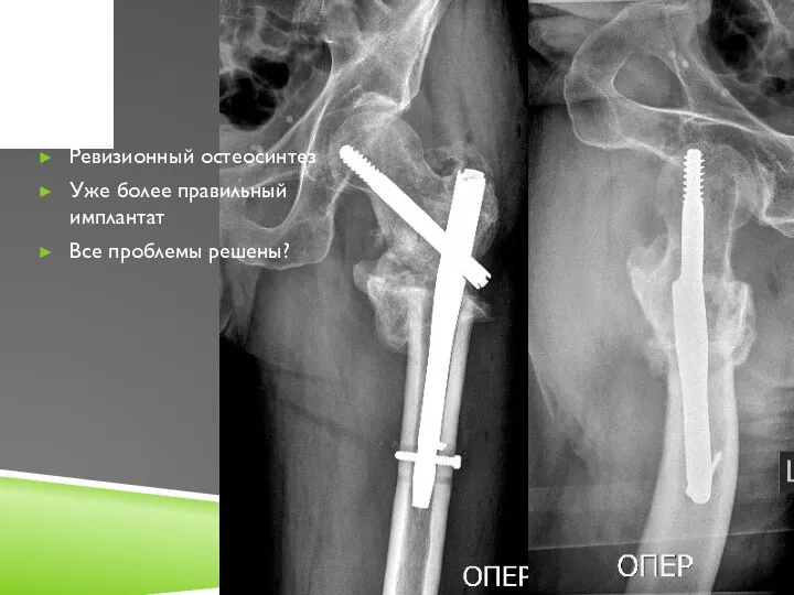 Ревизионный остеосинтез Уже более правильный имплантат Все проблемы решены?