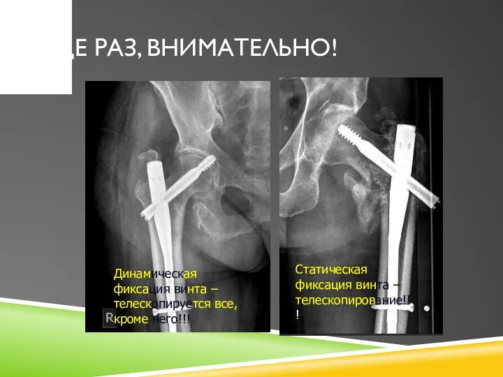 ЕЩЕ РАЗ, ВНИМАТЕЛЬНО! Статическая фиксация винта – телескопирование!!! Динамическая фиксация винта –телескопируется все, кроме него!!!