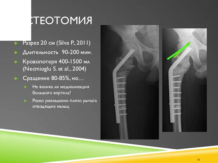 ОСТЕОТОМИЯ Разрез 20 см (Silva P., 2011) Длительность 90-200 мин.