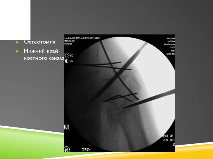 Остеотомия Нижний край костного канала