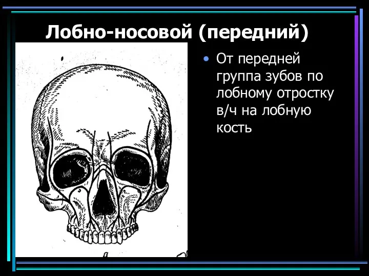 Лобно-носовой (передний) От передней группа зубов по лобному отростку в/ч на лобную кость