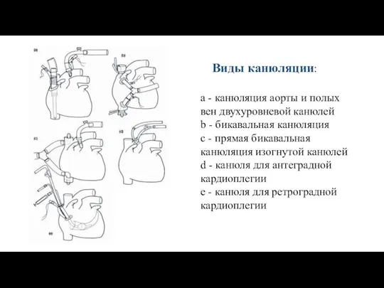 a - канюляция аорты и полых вен двухуровневой канюлей b