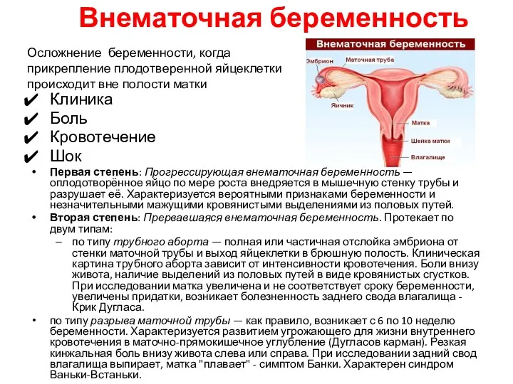 Внематочная беременность Клиника Боль Кровотечение Шок Первая степень: Прогрессирующая внематочная