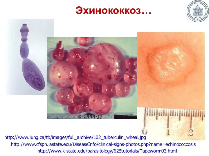 Эхинококкоз… http://www.k-state.edu/parasitology/625tutorials/Tapeworm03.html http://www.cfsph.iastate.edu/DiseaseInfo/clinical-signs-photos.php?name=echinococcosis http://www.lung.ca/tb/images/full_archive/102_tuberculin_wheal.jpg