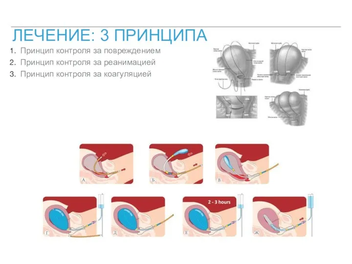 ЛЕЧЕНИЕ: 3 ПРИНЦИПА Принцип контроля за повреждением Принцип контроля за реанимацией Принцип контроля за коагуляцией