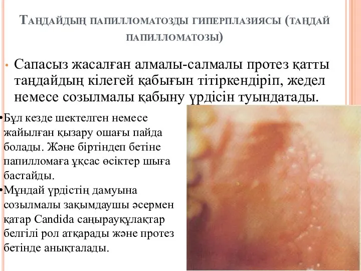 Таңдайдың папилломатозды гиперплазиясы (таңдай папилломатозы) Сапасыз жасалған алмалы-салмалы протез қатты