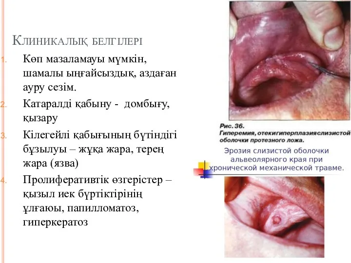 Клиникалық белгілері Көп мазаламауы мүмкін, шамалы ыңғайсыздық, аздаған ауру сезім.