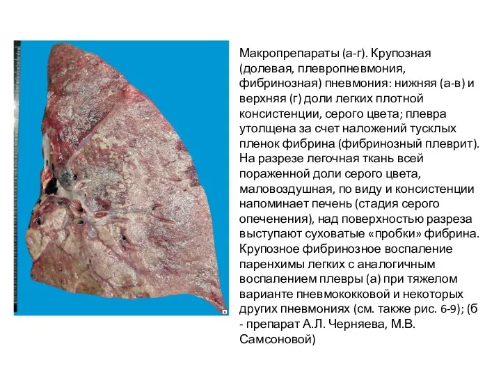 Макропрепараты (а-г). Крупозная (долевая, плевропневмония, фибринозная) пневмония: нижняя (а-в) и