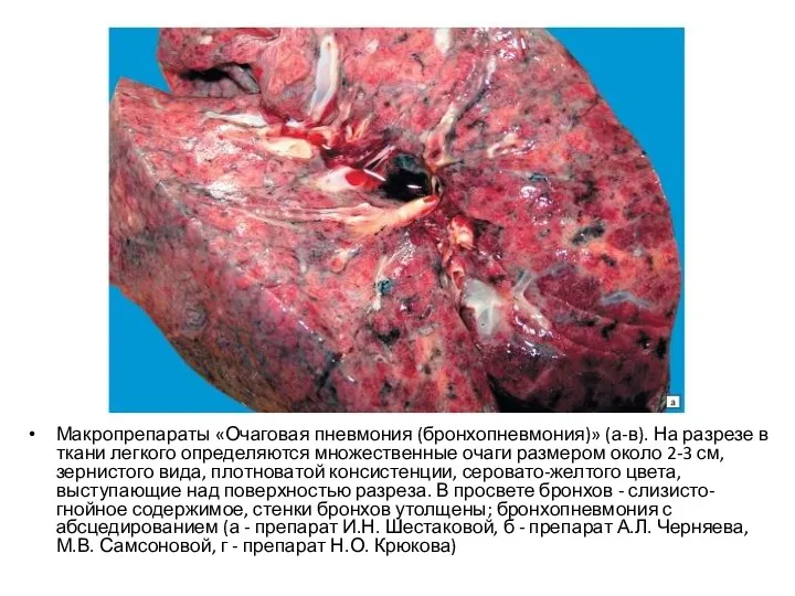 Макропрепараты «Очаговая пневмония (бронхопневмония)» (а-в). На разрезе в ткани легкого