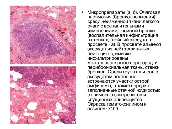 Микропрепараты (а, б). Очаговая пневмония (бронхопневмония): среди неизменной ткани легкого