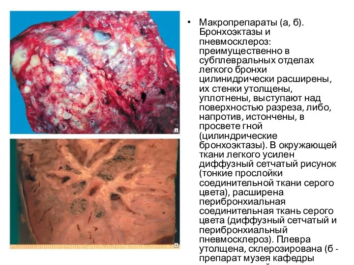 Макропрепараты (а, б). Бронхоэктазы и пневмосклероз: преимущественно в субплевральных отделах