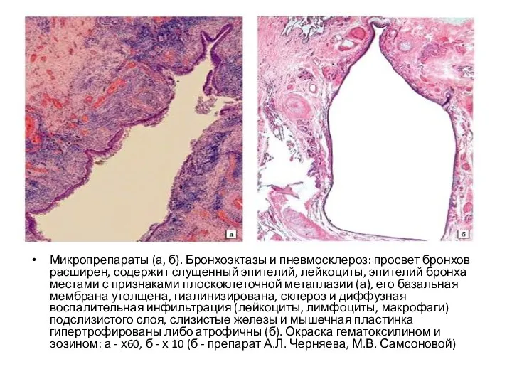 Микропрепараты (а, б). Бронхоэктазы и пневмосклероз: просвет бронхов расширен, содержит