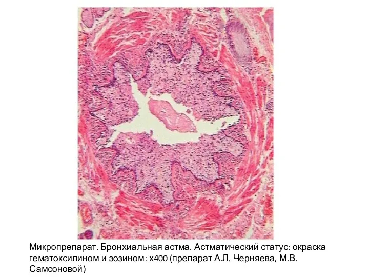 Микропрепарат. Бронхиальная астма. Астматический статус: окраска гематоксилином и эозином: х400 (препарат А.Л. Черняева, М.В. Самсоновой)