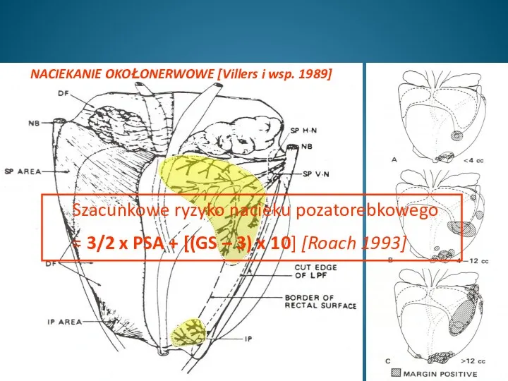 Szacunkowe ryzyko nacieku pozatorebkowego = 3/2 x PSA + [(GS