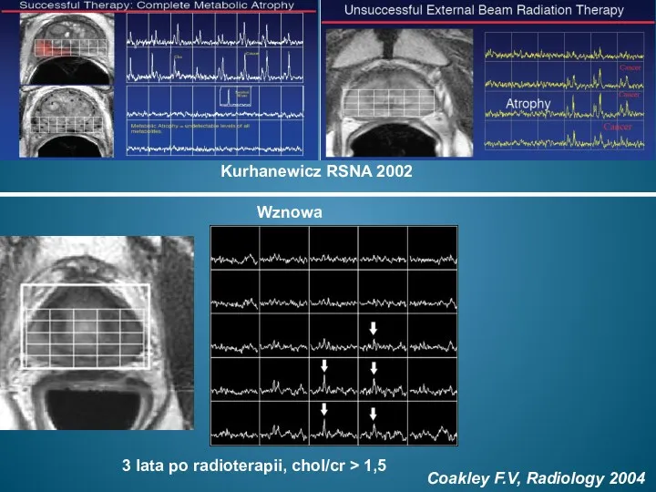 Kurhanewicz RSNA 2002 Wznowa 3 lata po radioterapii, chol/cr > 1,5 Coakley F.V, Radiology 2004