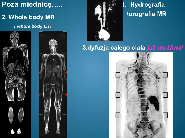 Poza miednicę….. Hydrografia /urografia MR 2. Whole body MR 3.dyfuzja