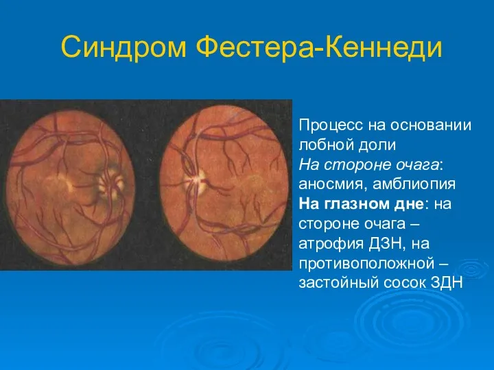 Синдром Фестера-Кеннеди Процесс на основании лобной доли На стороне очага: